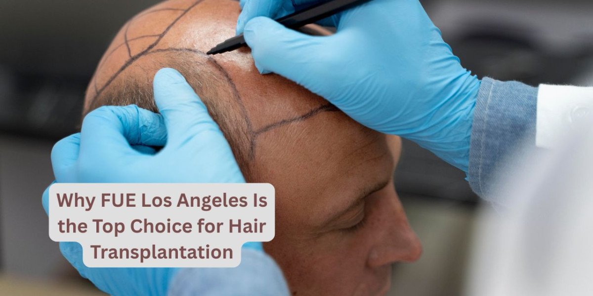 Why FUE Los Angeles Is the Top Choice for Hair Transplantation